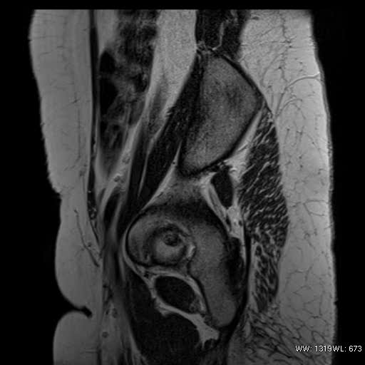 File:Bicornuate uterus- on MRI (Radiopaedia 49206-54297 Sagittal T2 1).jpg