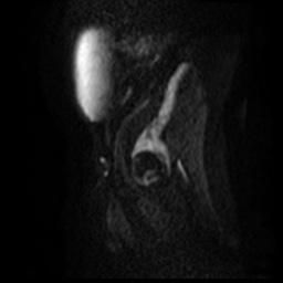 File:Bicornuate uterus (Radiopaedia 51676-57472 Sagittal DWI 26).jpg