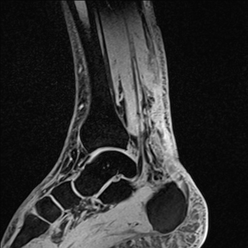 Bilateral Achilles tendon complete tear (Radiopaedia 81344-95051 Sagittal WE - Left 48).jpg