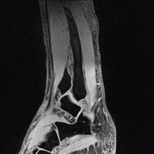 Bilateral Achilles tendon complete tear (Radiopaedia 81344-95051 Sagittal WE - Left 85).jpg