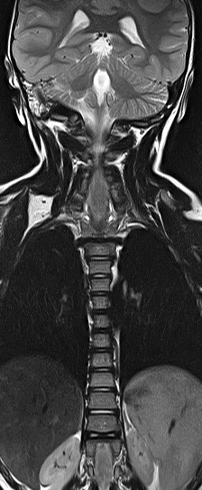 File:Bilateral Sprengel deformity with Klippel-Feil syndrome (Radiopaedia 66395-75650 F 6).jpg