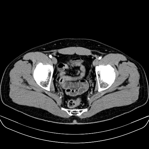 Bilateral accessory renal arteries with mild pelvi-ureteric junction (PUJ) obstruction (Radiopaedia 66357-75596 A 67).jpg