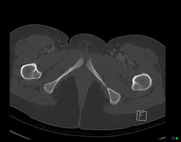 Bilateral acetabular fractures (Radiopaedia 79272-92308 Axial bone window 62).jpg