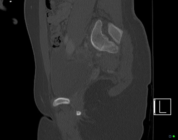 Bilateral acetabular fractures (Radiopaedia 79272-92308 Sagittal bone window 34).jpg