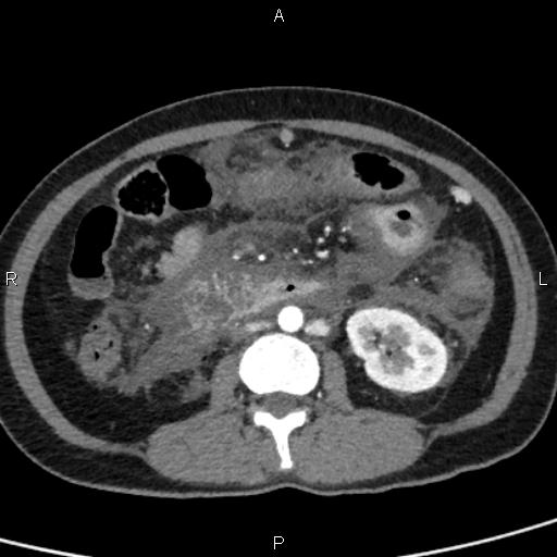 Bilateral adrenal gland hyperenhancement in pancreatitis (Radiopaedia 86642-102753 B 71).jpg