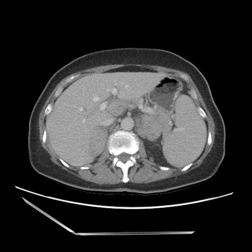 Bilateral adrenal granulocytic sarcomas (chloromas) (Radiopaedia 78375-91007 A 36).jpg