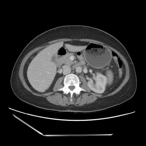 Bilateral adrenal granulocytic sarcomas (chloromas) (Radiopaedia 78375-91007 A 52).jpg