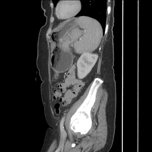 Bilateral adrenal granulocytic sarcomas (chloromas) (Radiopaedia 78375-91007 C 103).jpg
