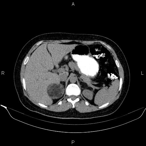 Bilateral adrenal myelolipoma (Radiopaedia 63058-71535 Axial non-contrast 43).jpg