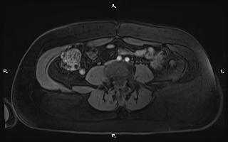 File:Bilateral adrenal myelolipoma (Radiopaedia 63058-71537 Axial T1 C+ fat sat 74).jpg