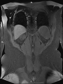 File:Bilateral adrenal myelolipoma (Radiopaedia 63058-71537 Coronal T1 fat sat 17).jpg