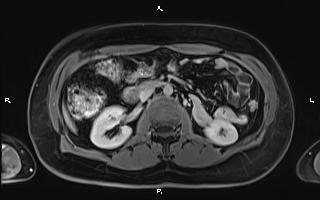 Bilateral adrenal myelolipoma (Radiopaedia 63058-71537 H 52).jpg