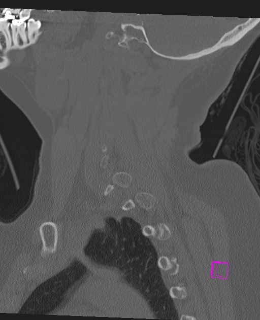 Bilateral atlanto-occipital assimilation (Radiopaedia 28350-28603 Sagittal bone window 21).jpg