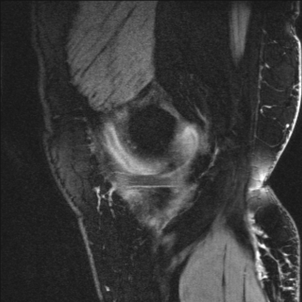Bilateral focal pigmented villonodular synovitis (Radiopaedia 67643-77046 G 11).jpg