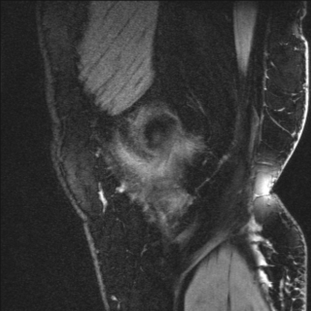 Bilateral focal pigmented villonodular synovitis (Radiopaedia 67643-77046 G 9).jpg