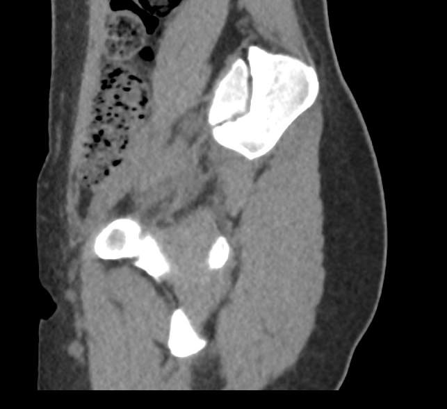 File:Bilateral mature cystic ovarian teratoma (Radiopaedia 88821-105592 D 5).jpg