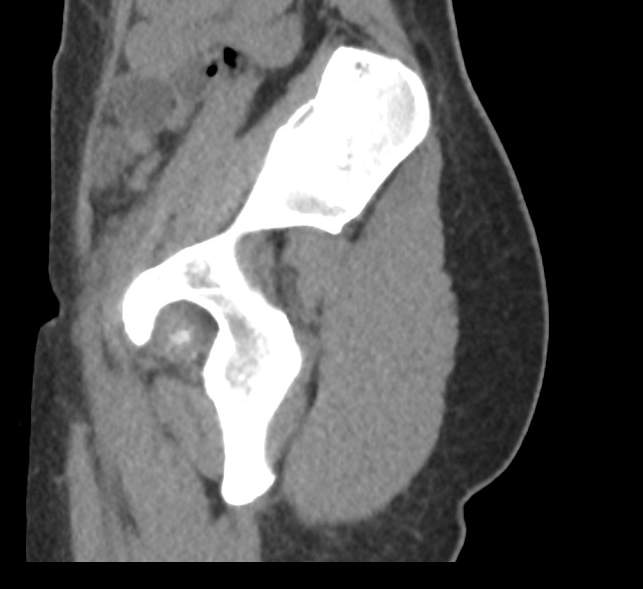Bilateral mature cystic ovarian teratoma (Radiopaedia 88821-105592 D 63).jpg