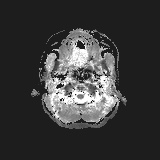 File:Bilateral mesial temporal polymicrogyria (Radiopaedia 76456-88181 Axial ADC 1).jpg