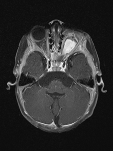 File:Bilateral optic pathway gliomas (Radiopaedia 40013-42514 Axial T1 C+ fat sat 3).jpg