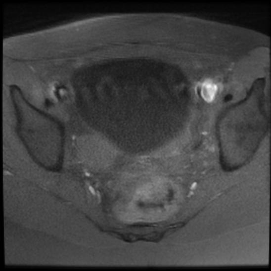 File:Bilateral ovarian fibrothecomas - adolescent (Radiopaedia 86604-102707 Axial T1 fat sat 18).jpg