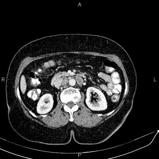 Bilateral ovarian serous cystadenocarcinoma (Radiopaedia 86062-101989 B 42).jpg