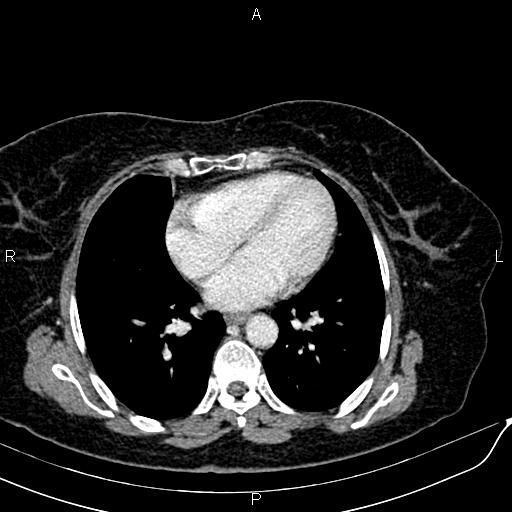 Bilateral ovarian serous cystadenocarcinoma (Radiopaedia 86062-101989 B 5).jpg