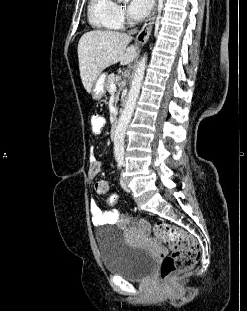 Bilateral ovarian serous cystadenocarcinoma (Radiopaedia 86062-101989 E 43).jpg