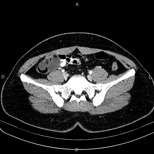 File:Bilateral ovarian teratoma (Radiopaedia 83131-97503 Axial With contrast 21).jpg