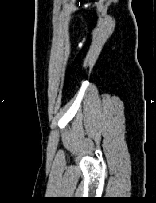 Bilateral ovarian teratoma (Radiopaedia 83131-97503 D 25).jpg