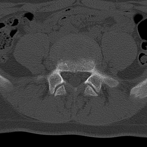 Bilateral pars defect (Radiopaedia 26691-26846 Axial bone window 47).jpg