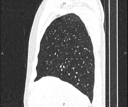 Bilateral pulmonary AVM (Radiopaedia 83134-97505 Sagittal lung window 34).jpg