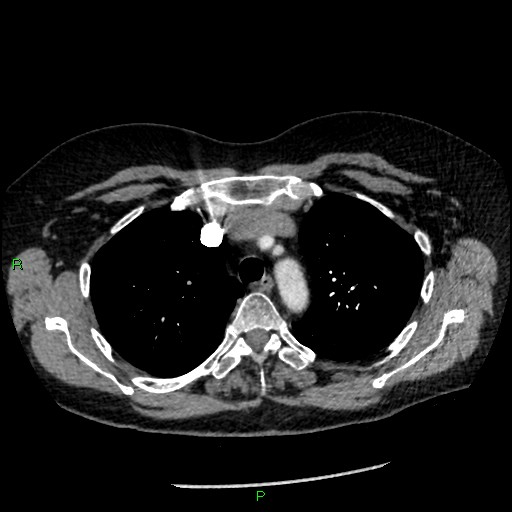 Bilateral pulmonary emboli (Radiopaedia 32700-33669 Axial C+ CTPA 29).jpg