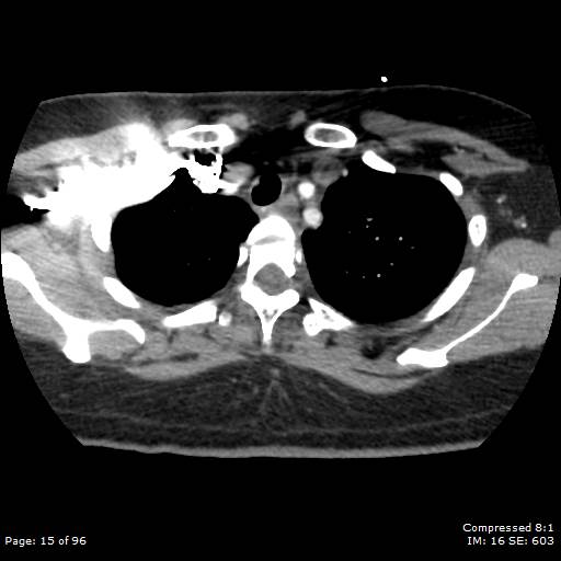 File:Bilateral pulmonary emboli with Hampton hump sign (Radiopaedia 54070-60246 Axial C+ CTPA 12).jpg
