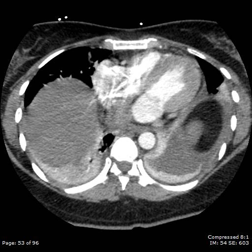 Bilateral pulmonary emboli with Hampton hump sign (Radiopaedia 54070-60246 Axial C+ CTPA 50).jpg