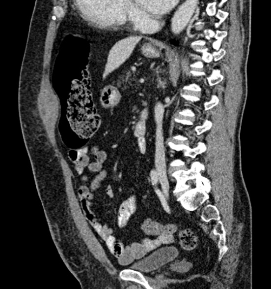 Bilateral rectus sheath hematomas (Radiopaedia 50778-56252 B 47).jpg