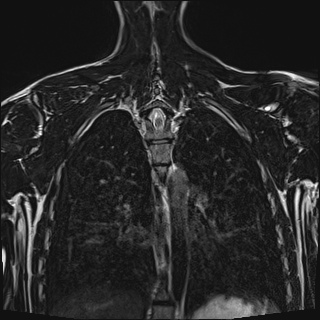 Bilateral spinoglenoid notch ganglion cysts (Radiopaedia 29577-30082 Coronal T2 92).jpg