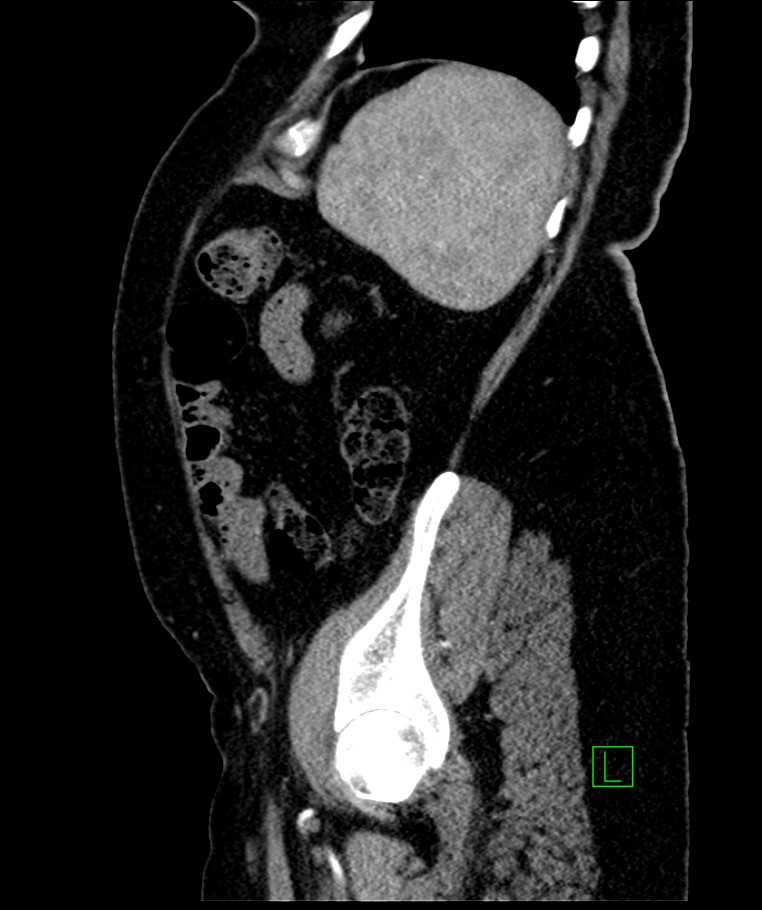 Bilateral sporadic synchronous clear cell renal cell carcinoma (Radiopaedia 85035-100575 E 30).jpg