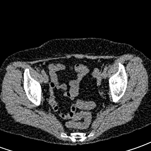 Bilateral staghorn calculi (Radiopaedia 59475-66842 Axial non-contrast 73).jpg