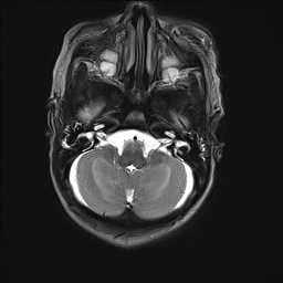 File:Bilateral subdural hemorrhage and parietal skull fracture (Radiopaedia 26058-26190 Axial T2 8).png