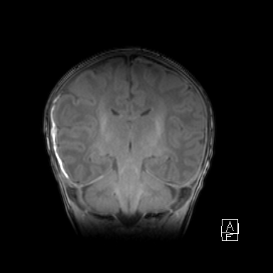 File:Bilateral subdural hemorrhage and parietal skull fracture (Radiopaedia 26058-26190 Coronal T1 32).png