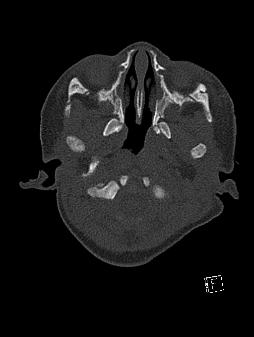Bilateral subdural hemorrhage and parietal skull fracture (Radiopaedia 26058-26192 Axial bone window 119).png