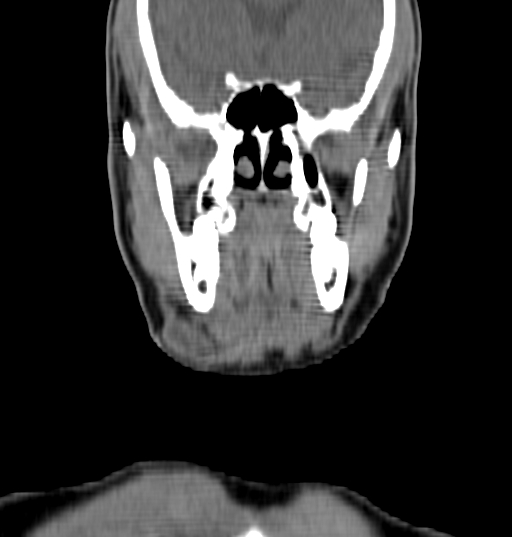 File:Bilateral submandibular sialolithiasis with sialadenitis (Radiopaedia 70721-80881 Coronal non-contrast 1).jpg
