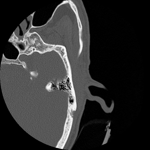 Bilateral temporal bone fractures (Radiopaedia 29482-29970 D 103).jpg