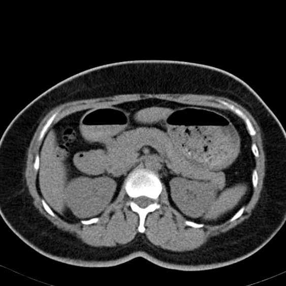File:Bilateral ureteric stents (Radiopaedia 48795-53825 Axial non-contrast 18).jpg