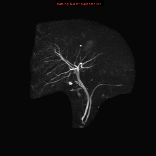 File:Biliary tree anatomical variant - biliary trifurcation (Radiopaedia 12531-12750 Coronal 3D MRCP 6).jpg