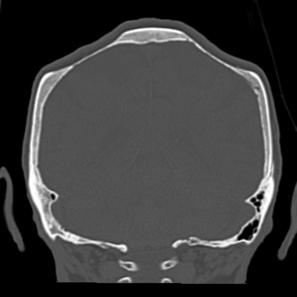 Biparietal osteodystrophy (Radiopaedia 46109-50463 Coronal bone window 75).jpg