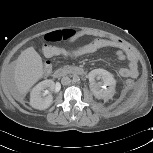 Bladder rupture post renal biopsy (Radiopaedia 30863-31572 Axial non-contrast 41).jpg