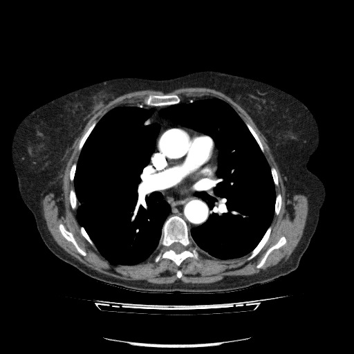 Bladder tumor detected on trauma CT (Radiopaedia 51809-57609 A 49).jpg