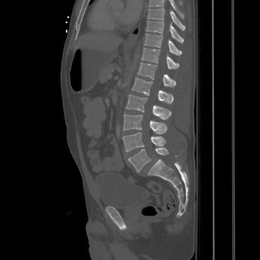 Blunt abdominal trauma with solid organ and musculoskelatal injury with active extravasation (Radiopaedia 68364-77895 Sagittal bone window 53).jpg