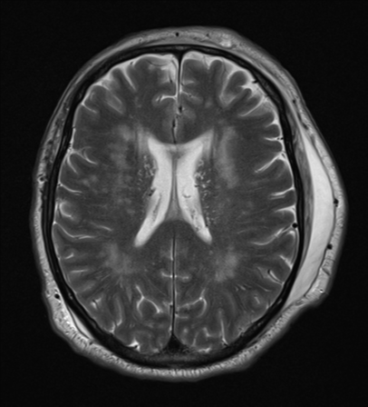 File:Blunt cerebrovascular injury (Radiopaedia 53682-59745 Axial T2 19).png